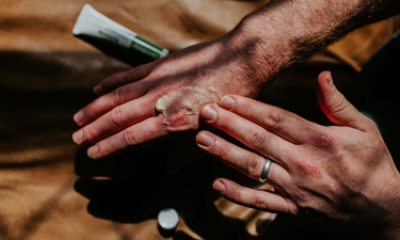 Close-up of someone's hand rubbing ointment into small burn on the other hand